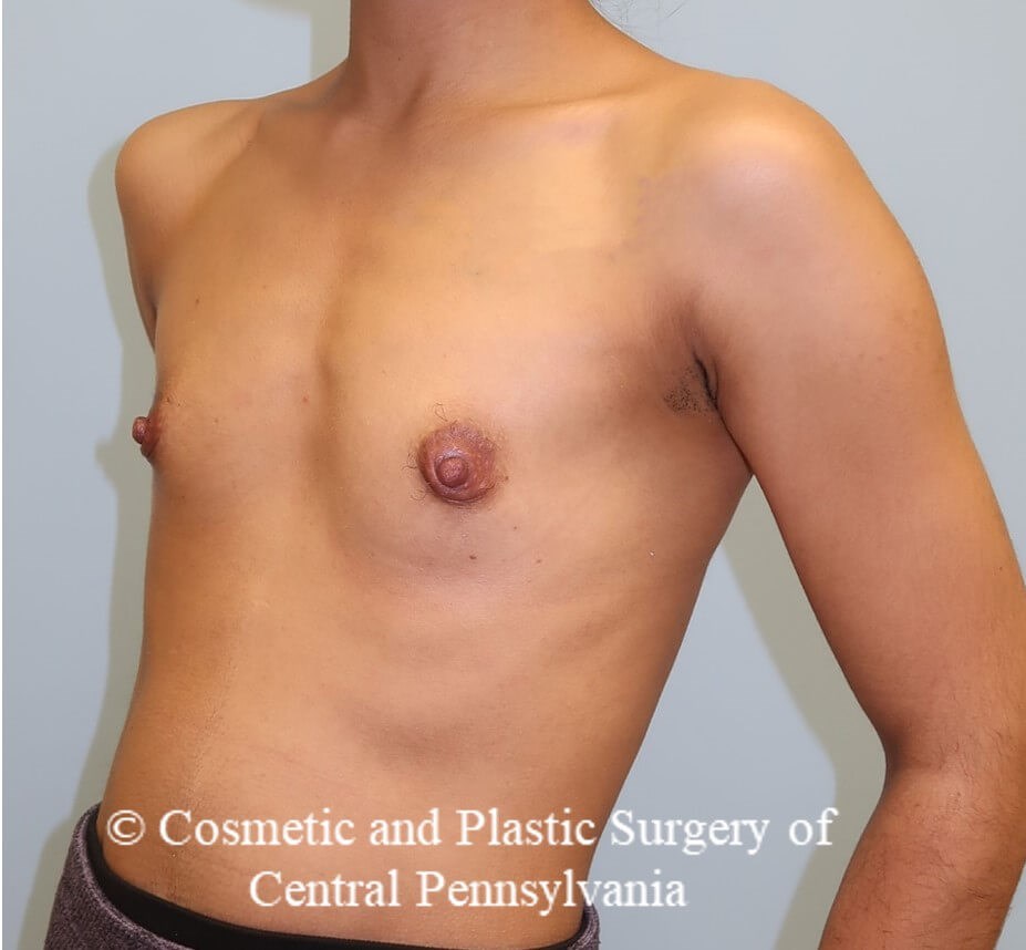 Breast Augmentation Before