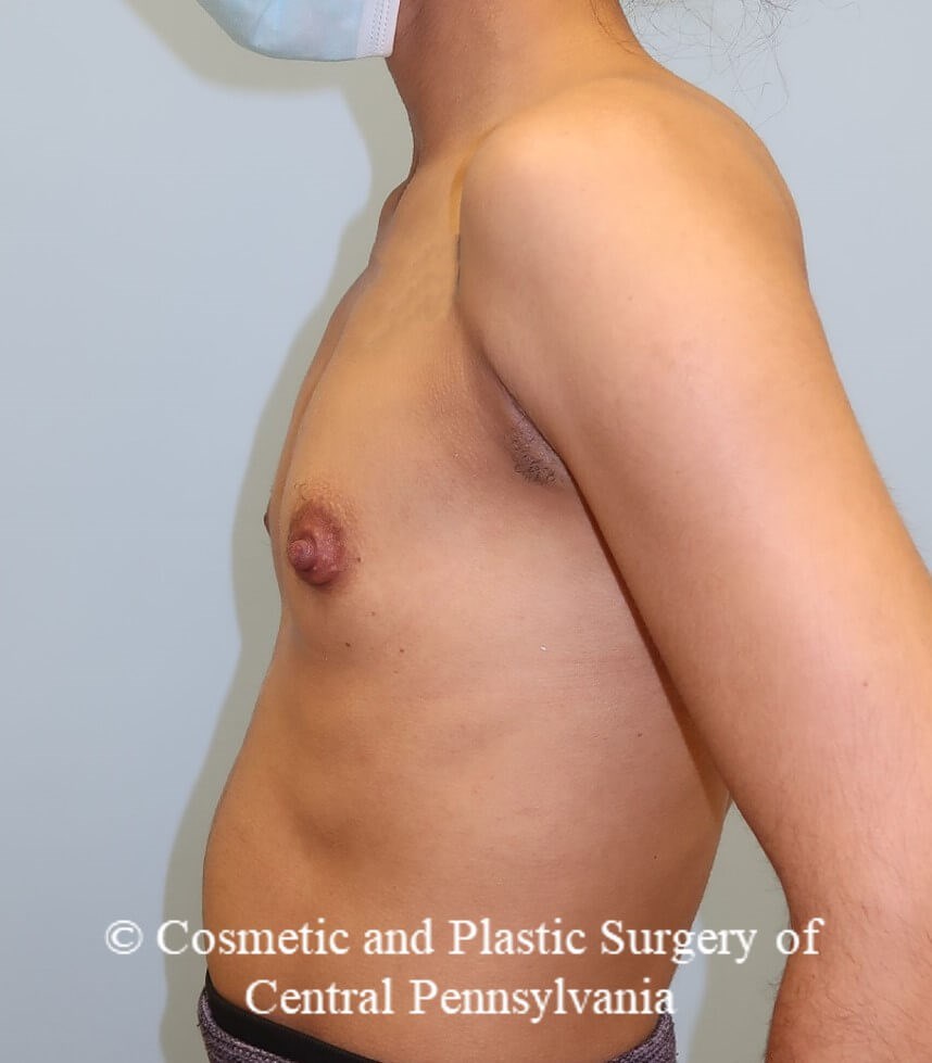 Breast Augmentation Before