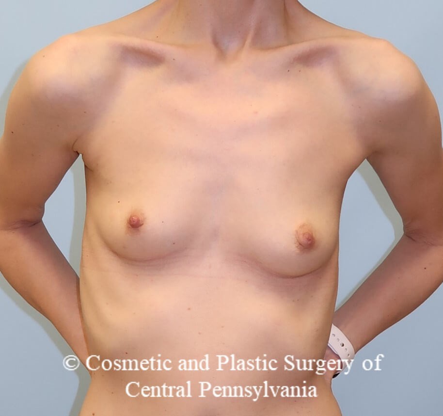 Breast Augmentation Before