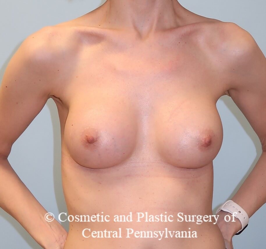 Breast Augmentation After
