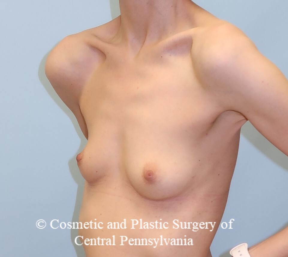 Breast Augmentation Before
