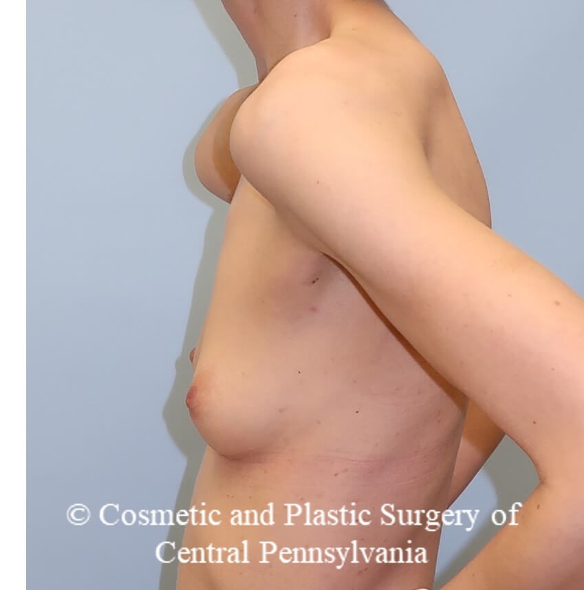 Breast Augmentation Before