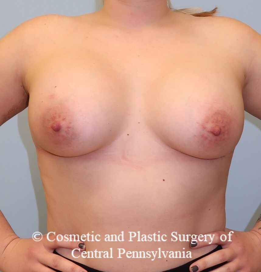 Breast Augmentation After