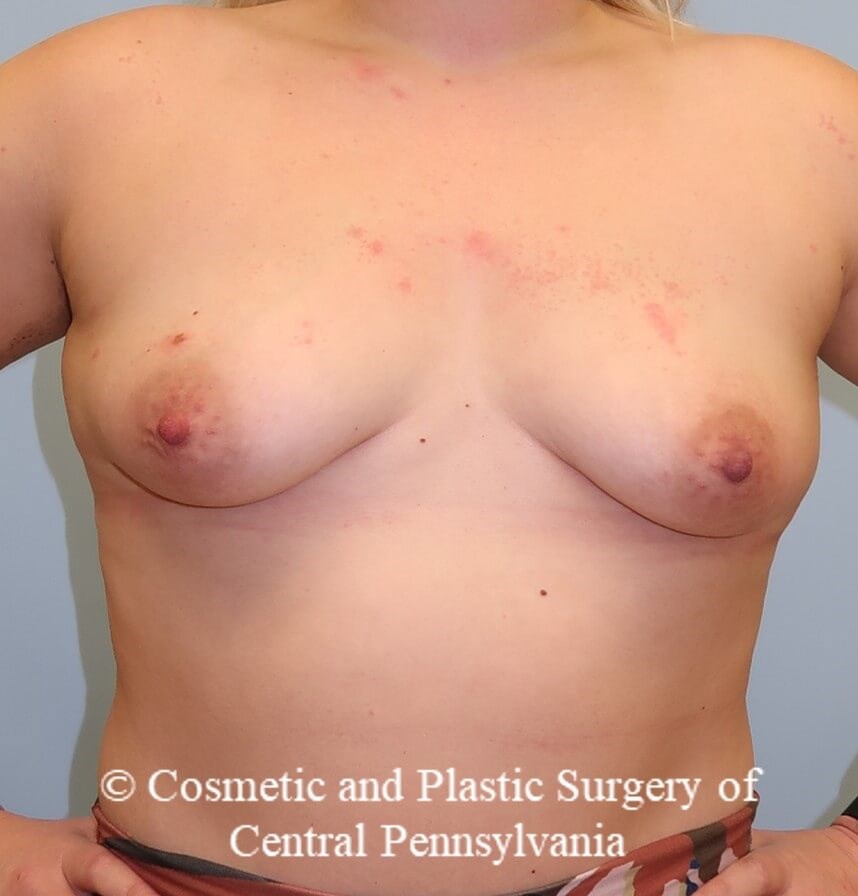 Breast Augmentation Before
