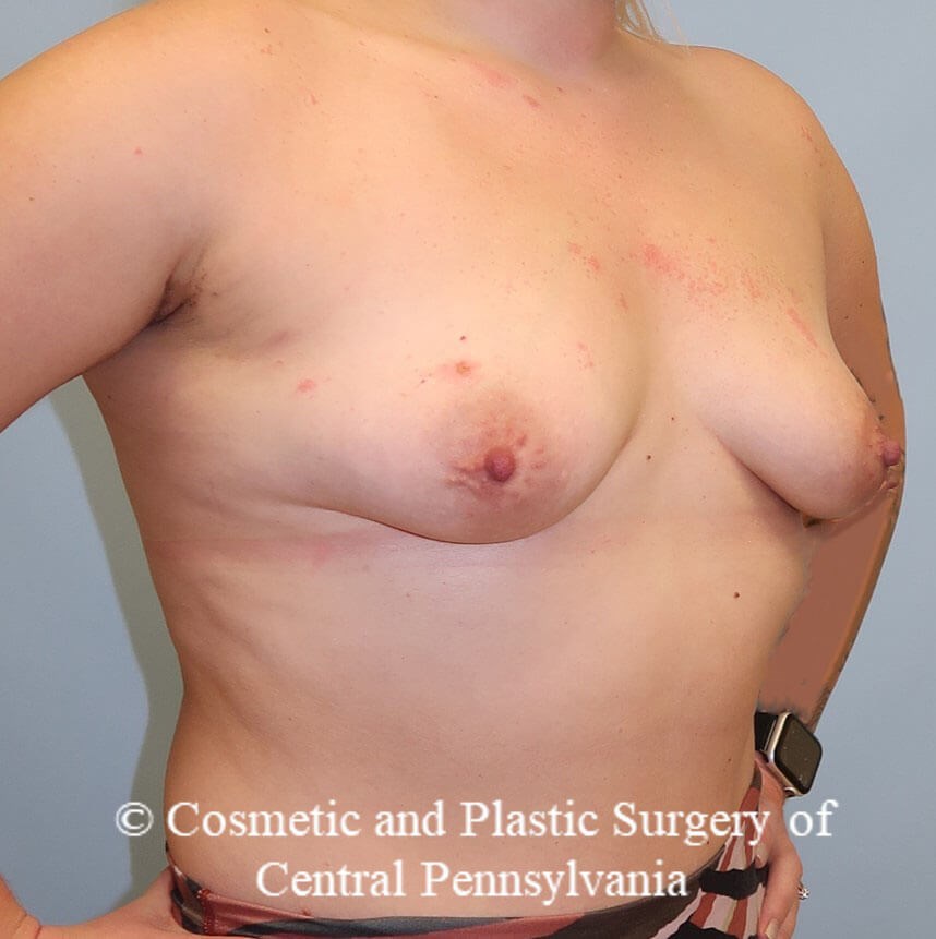 Breast Augmentation Before