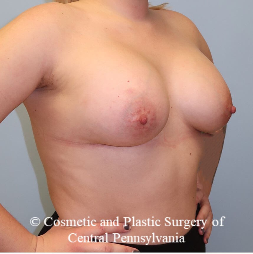 Breast Augmentation After