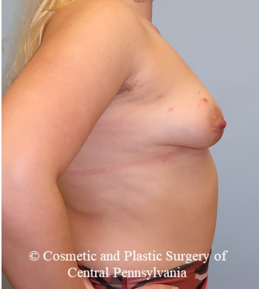Breast Augmentation Before