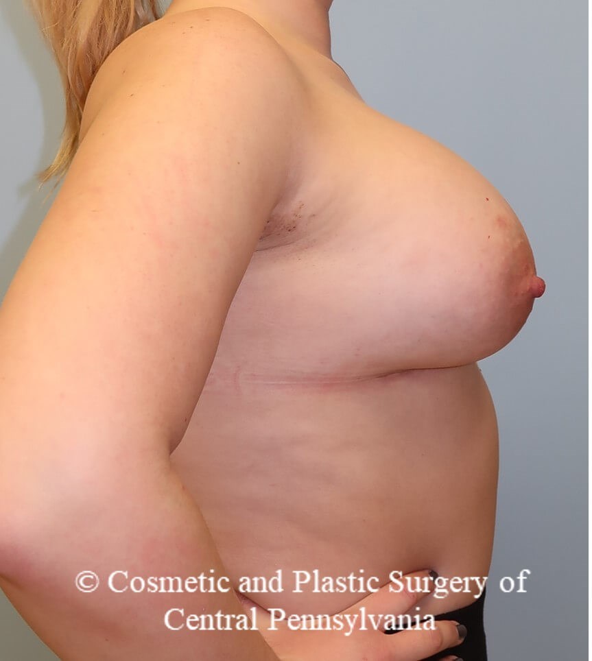 Breast Augmentation After