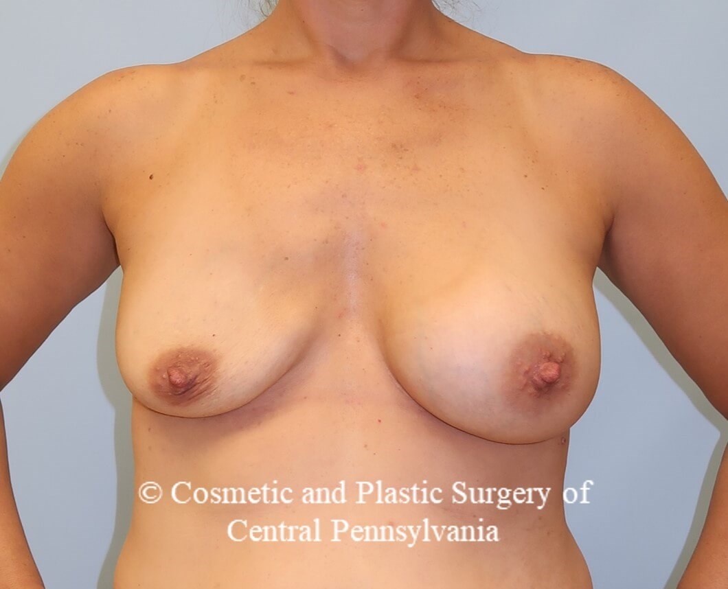 Breast Augmentation Revision Before