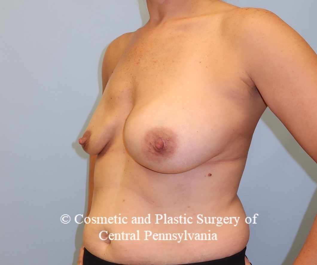 Breast Augmentation Revision Before