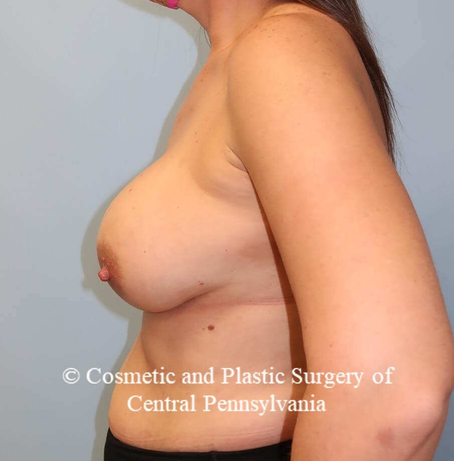 Breast Augmentation Revision After