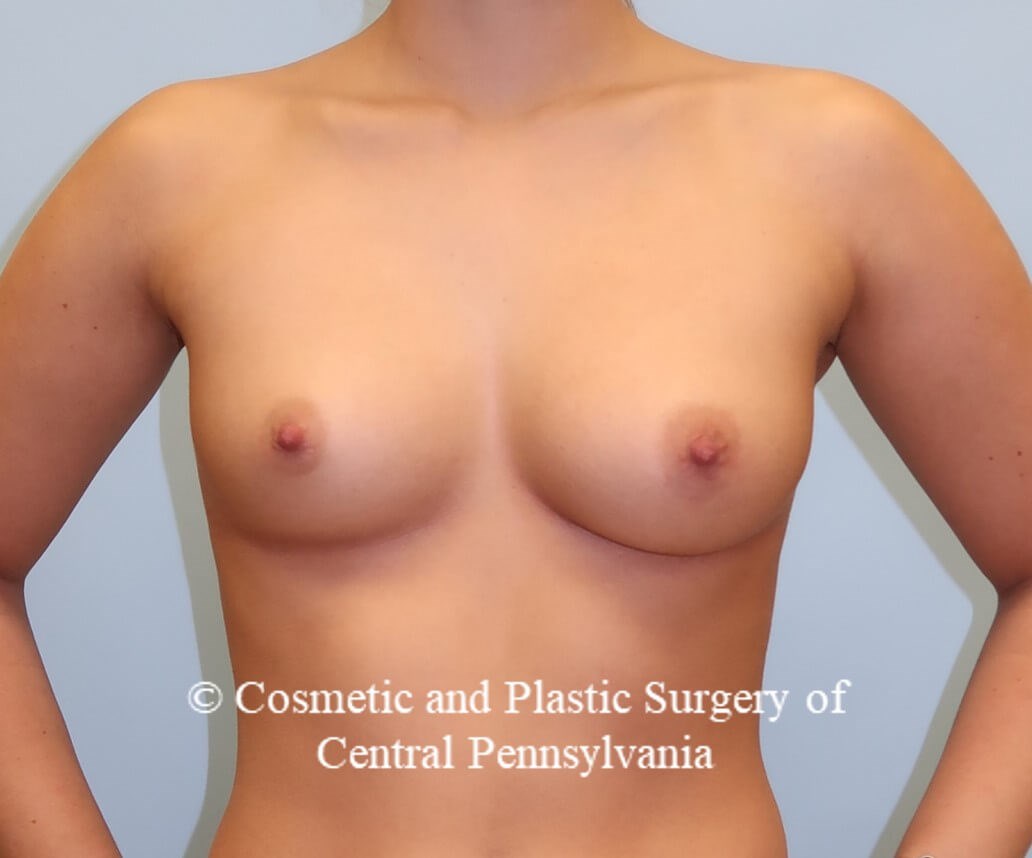 Breast Augmentation Before