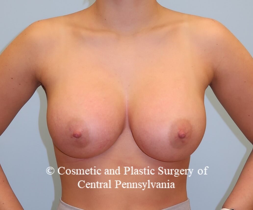 Breast Augmentation After
