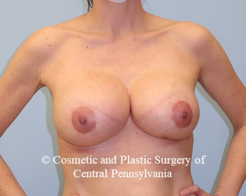 Breast Augmentation Lift After