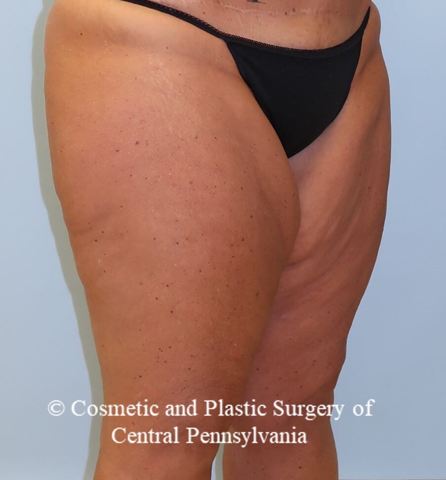 Thighplasty Before
