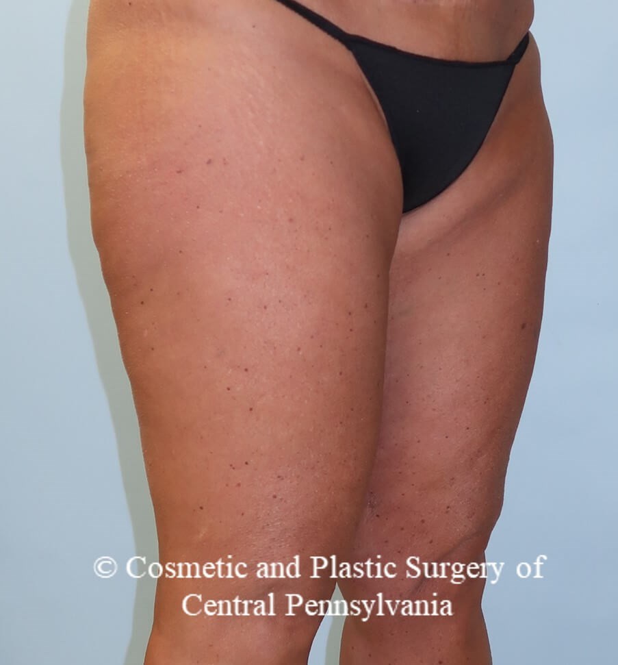 Thighplasty After