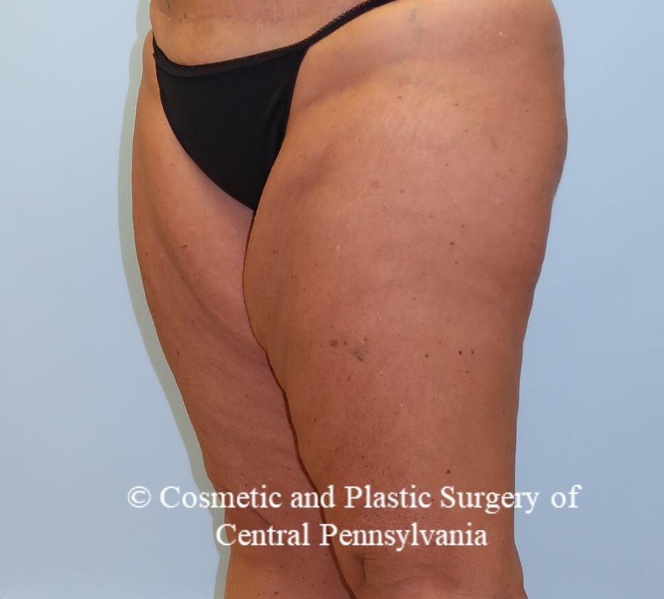 Thighplasty Before