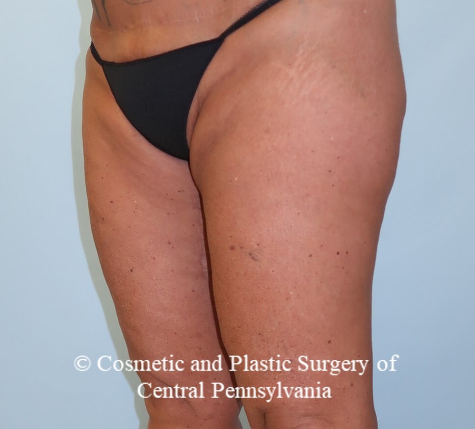 Thighplasty After