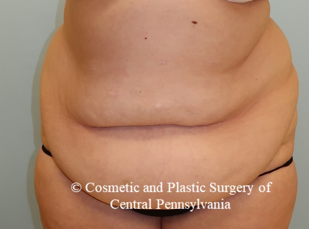Panniculectomy (tummy tuck) Before