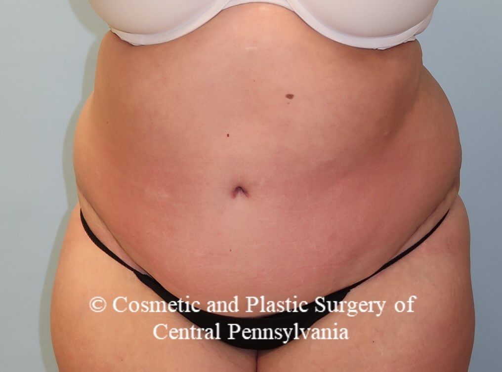 Panniculectomy (tummy tuck) After