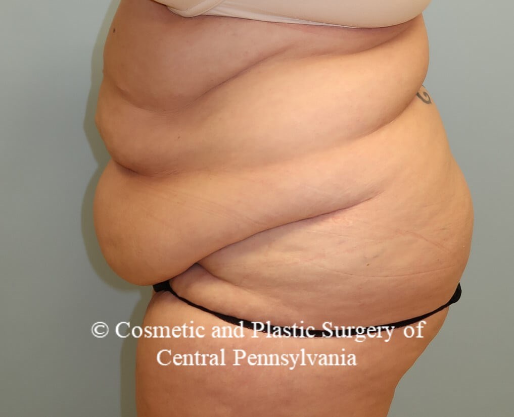 Panniculectomy (tummy tuck) Before