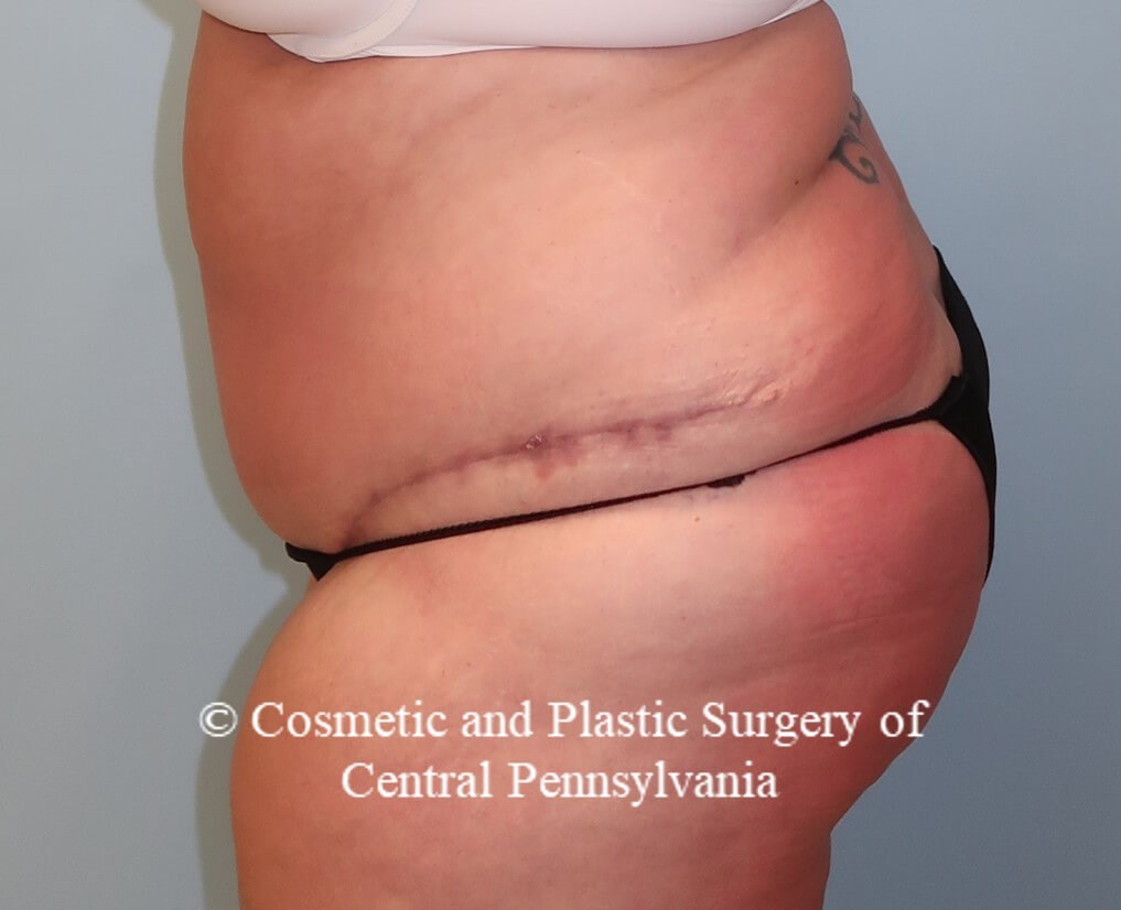 Panniculectomy (tummy tuck) After