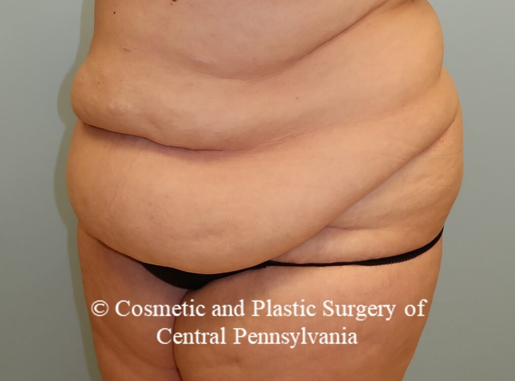 Panniculectomy (tummy tuck) Before