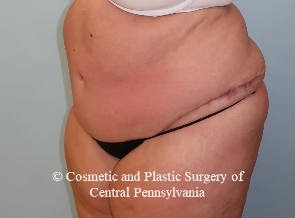 Panniculectomy (tummy tuck) After