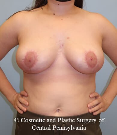 Breast Reduction After