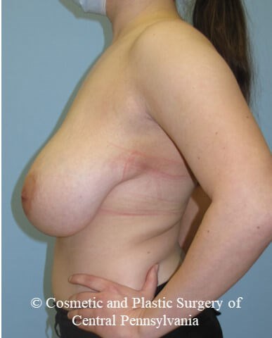 Breast Reduction Before