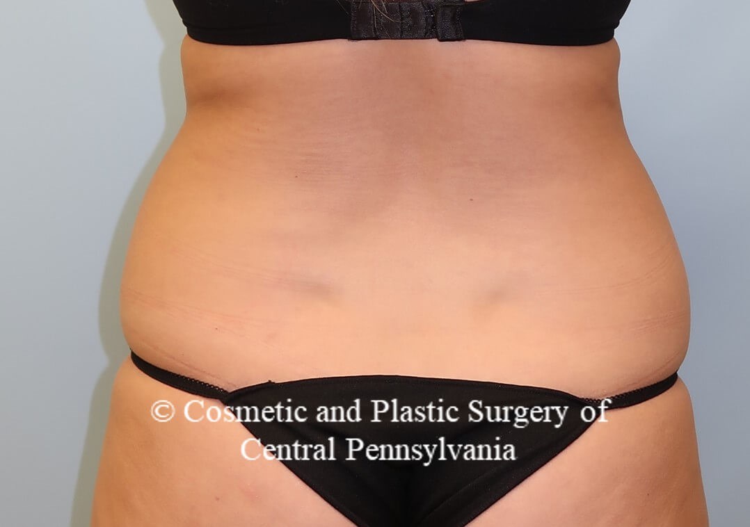 Liposuction Before