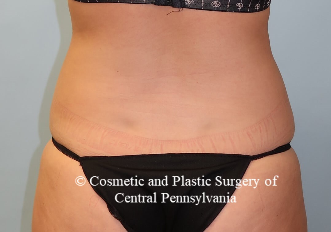 Liposuction After