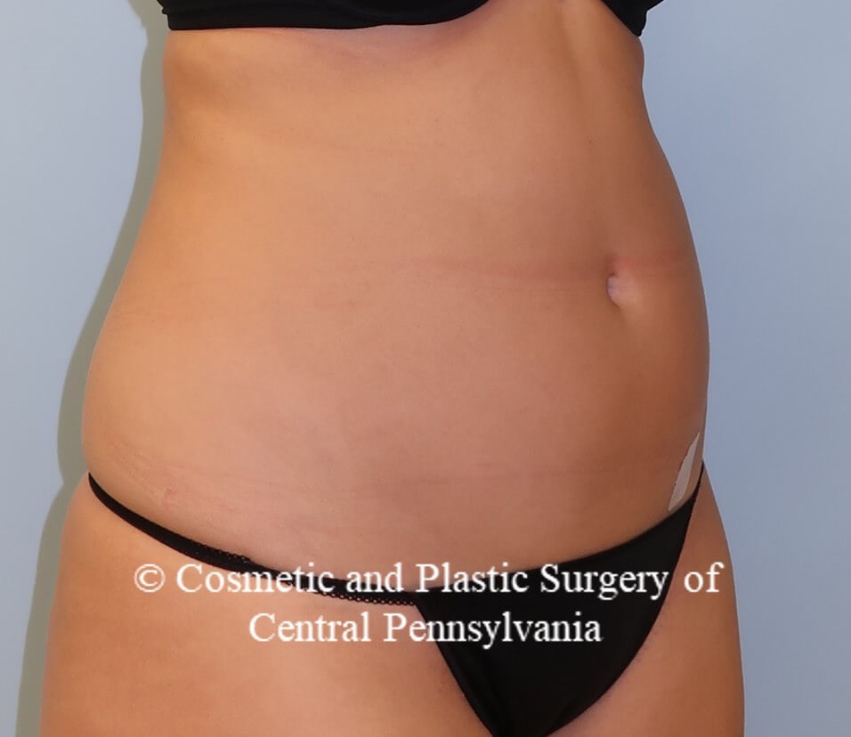 Liposuction Before