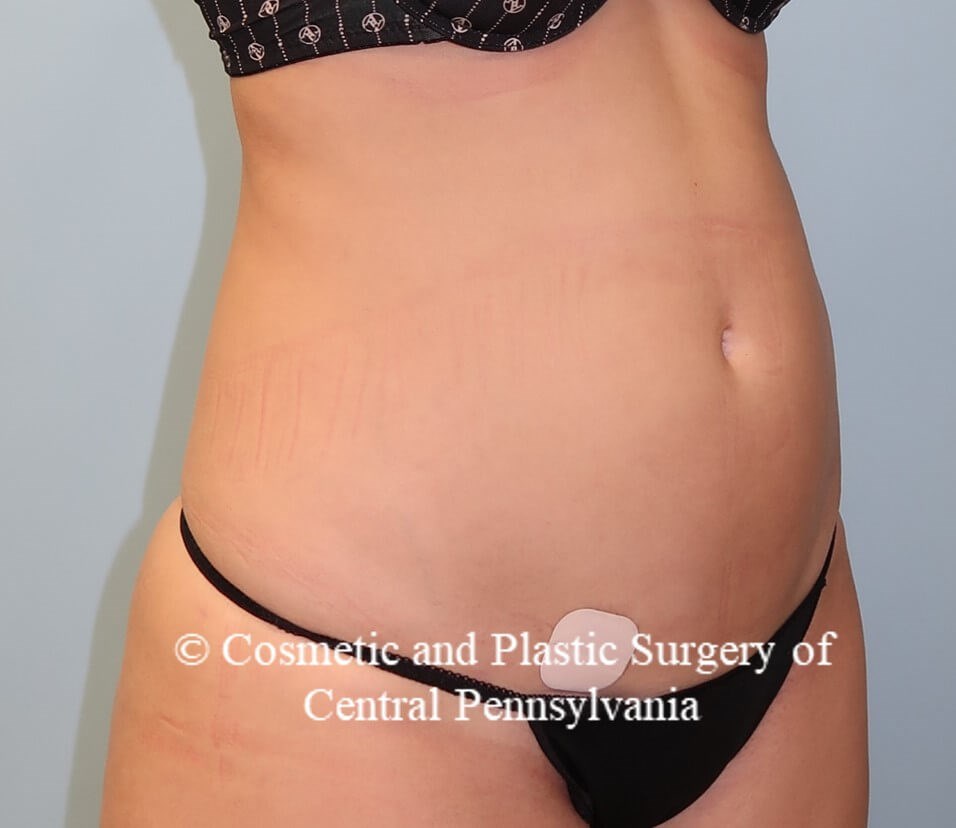 Liposuction After