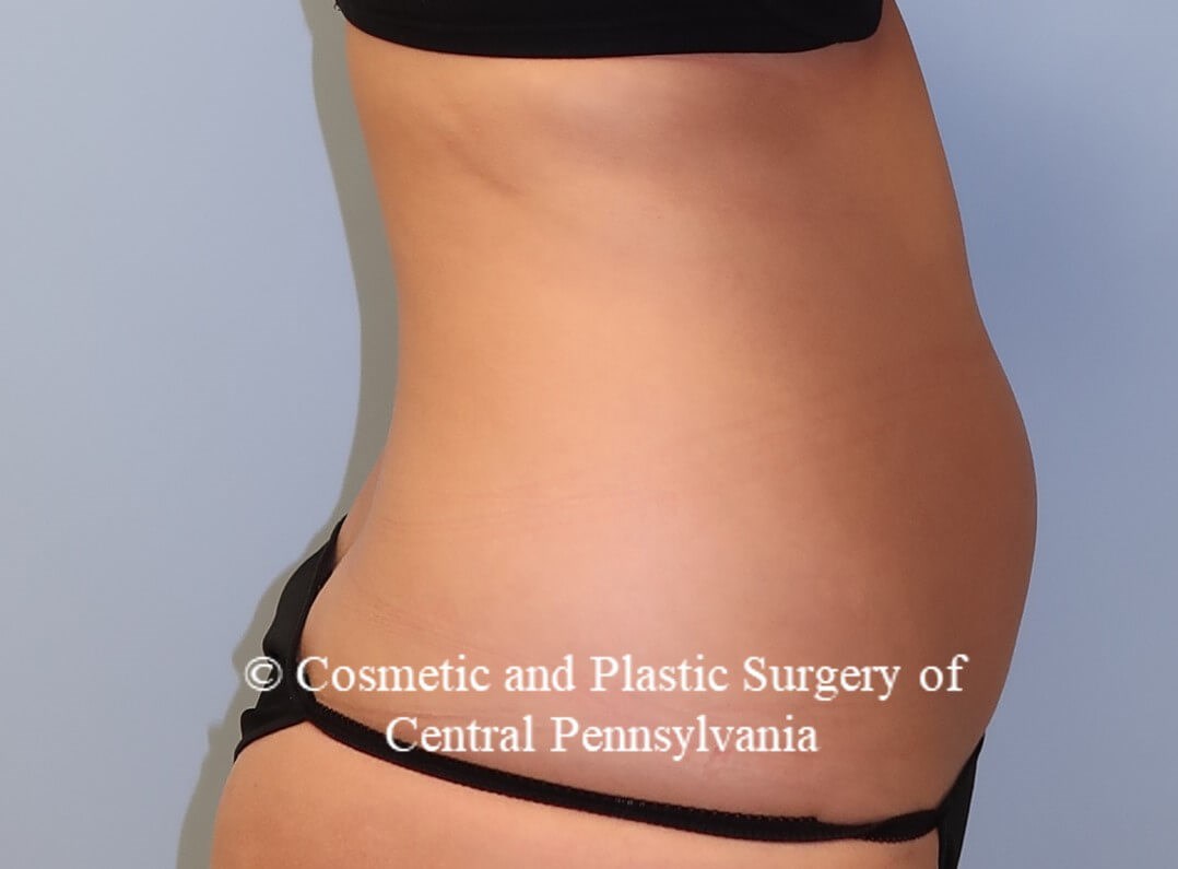 Liposuction Before