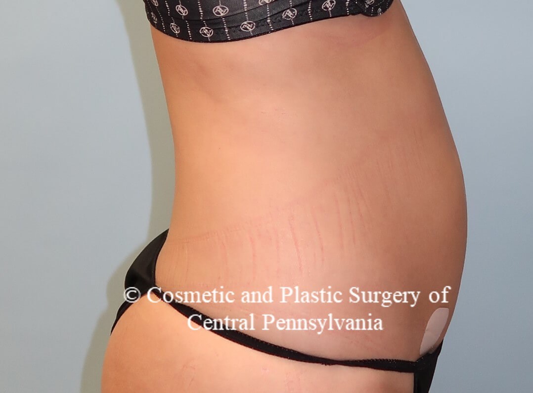 Liposuction After