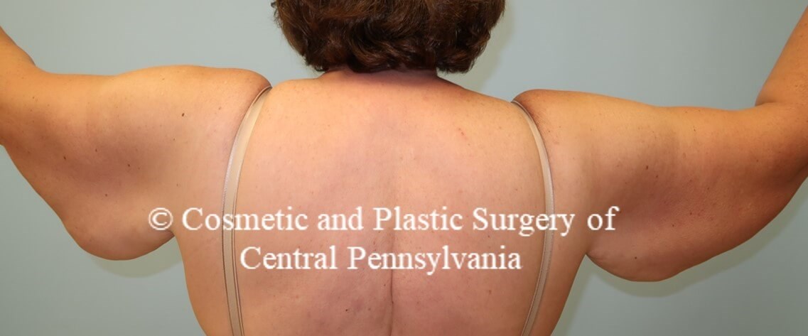 Brachioplasty (arm lift) Before