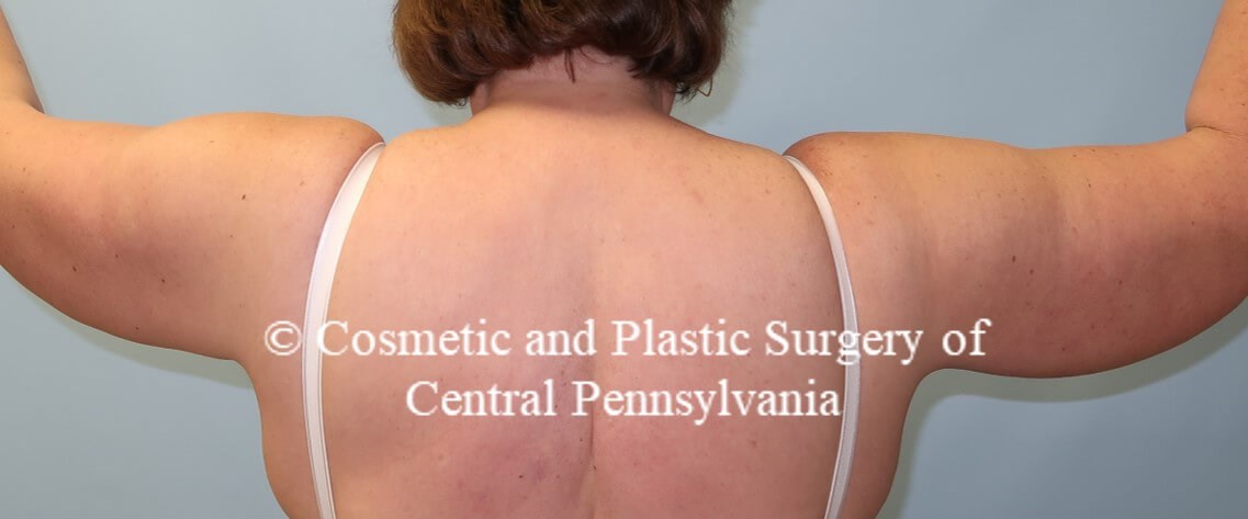 Brachioplasty (arm lift) After