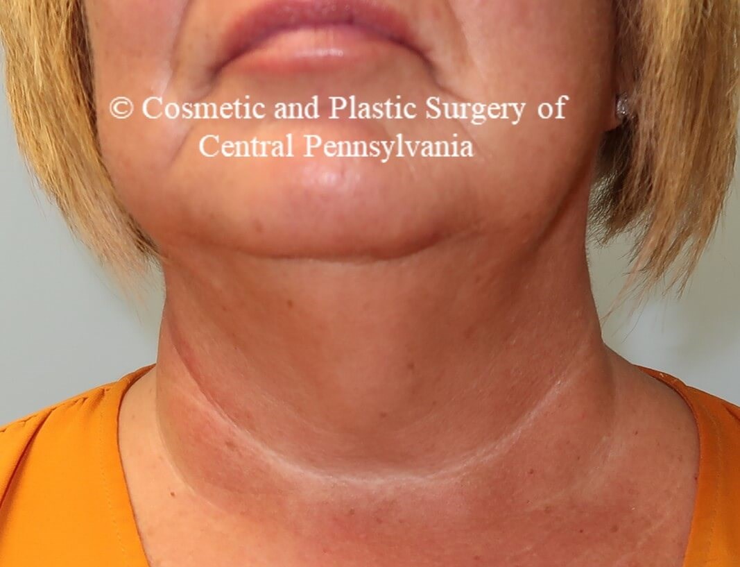 Necklift with platysmaplasty Before