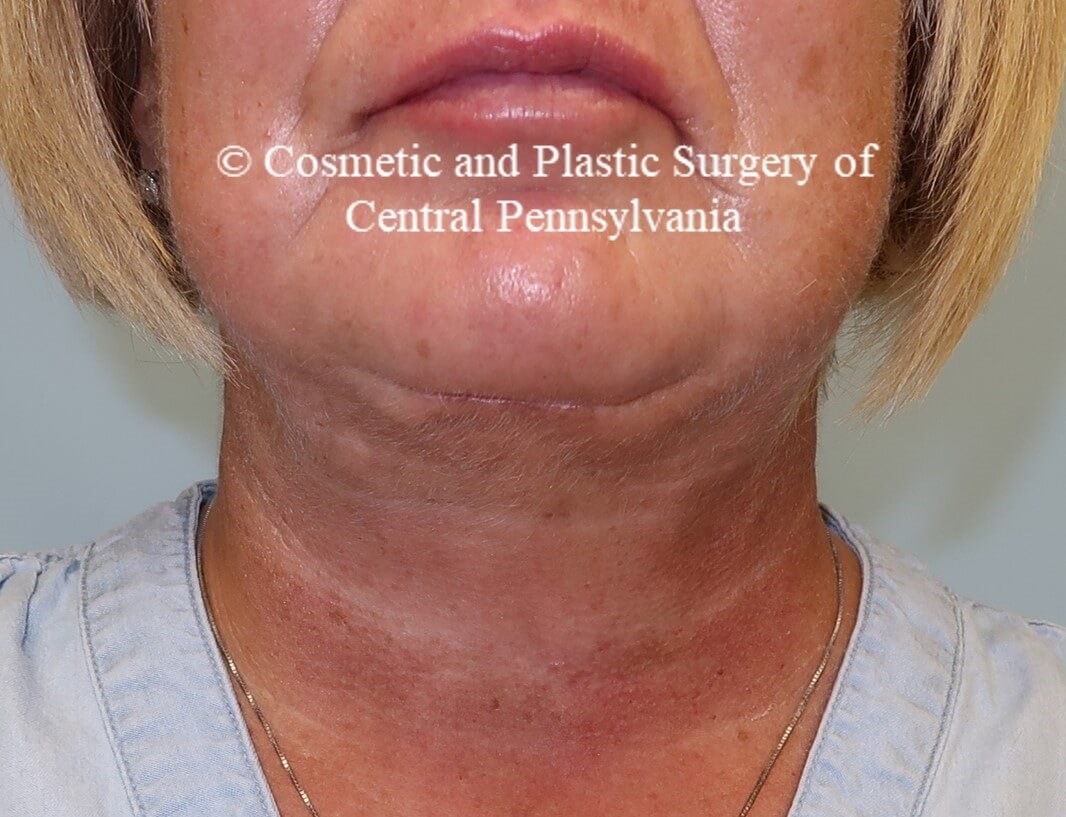 Necklift with platysmaplasty After