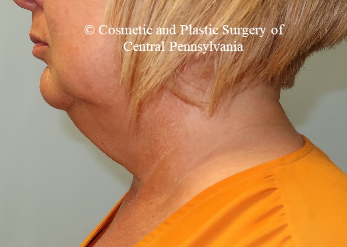 Necklift with platysmaplasty Before