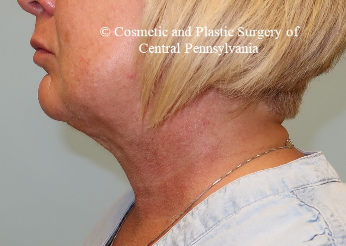 Necklift with platysmaplasty After