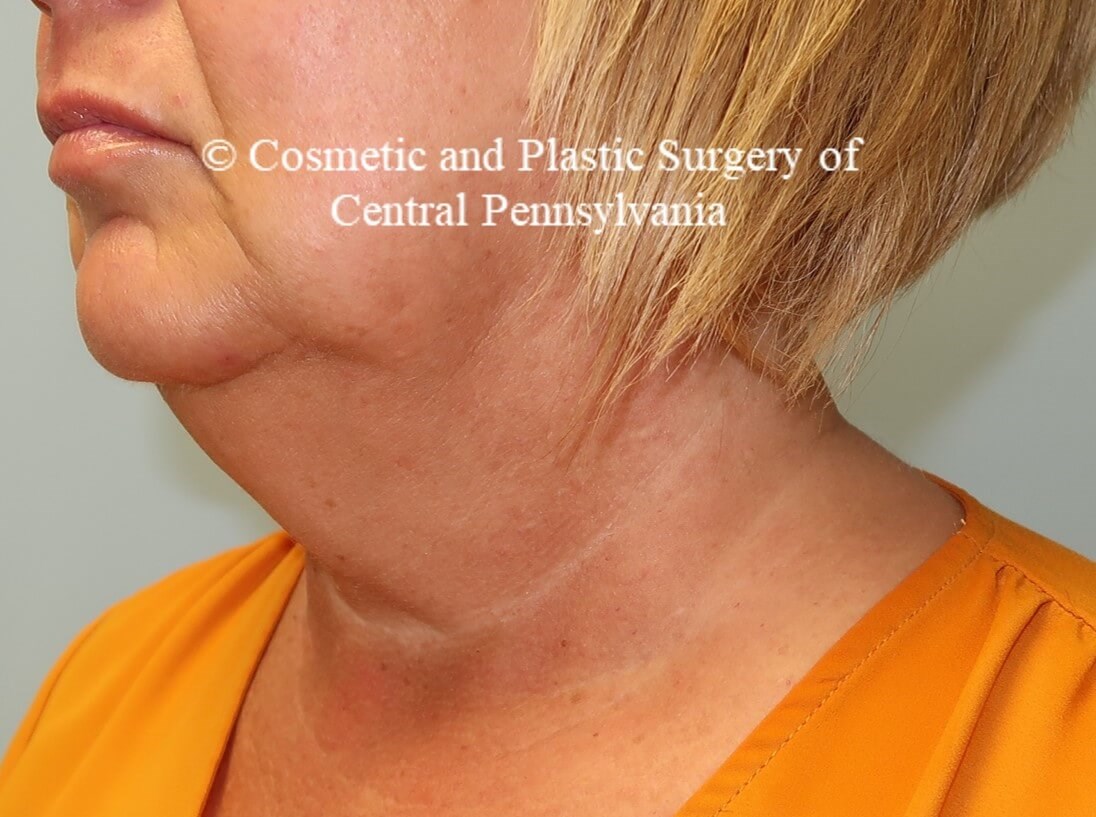 Necklift with platysmaplasty Before