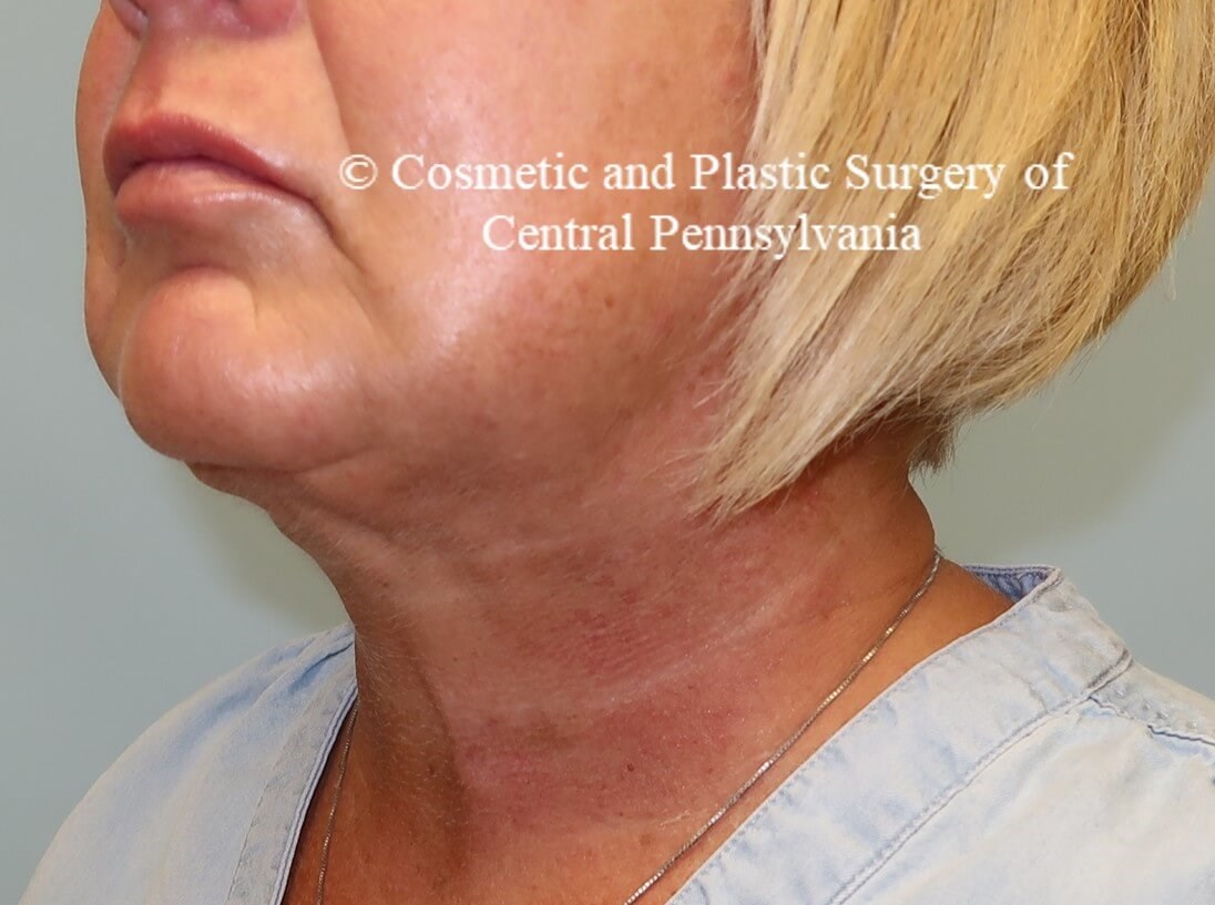 Necklift with platysmaplasty After