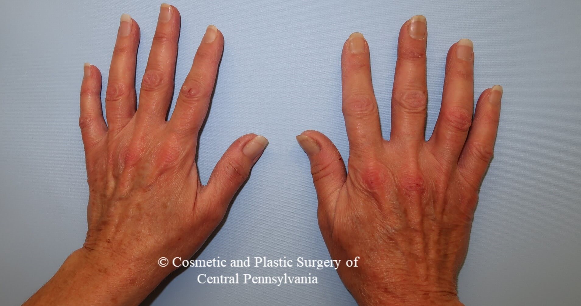 Hand Fat Grafting Before