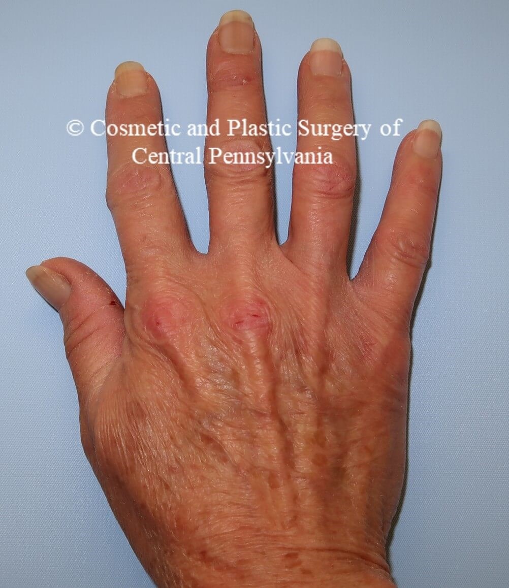 Hand Fat Grafting Before