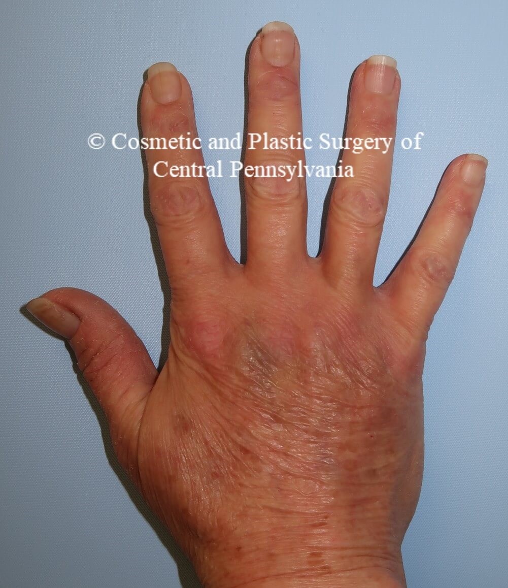 Hand Fat Grafting After