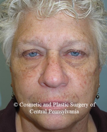 Blepharoplasty (upper eyelid) Before