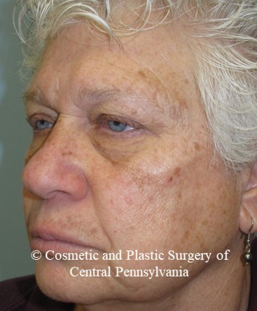 Blepharoplasty (upper eyelid) Before