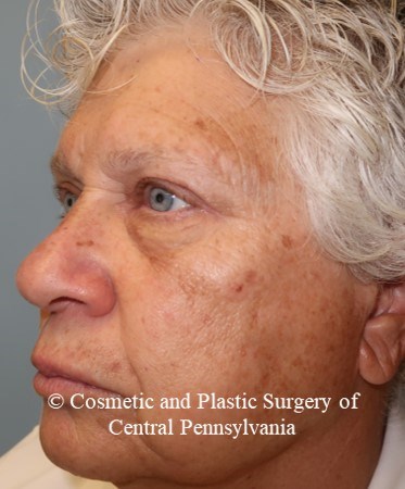 Blepharoplasty (upper eyelid) After